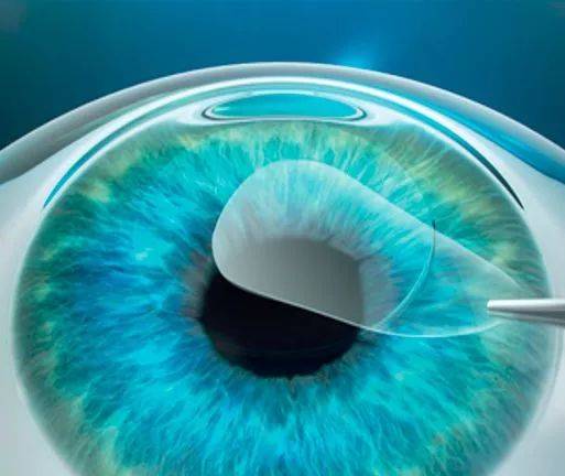 厦门眼科中心漳州眼科医院：不同术式的术后专属注意事项